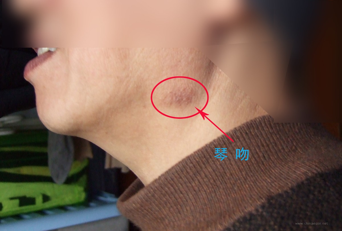 箭头处就是“琴吻”。